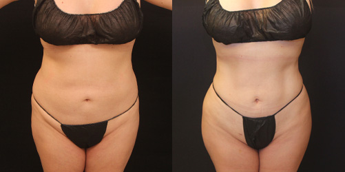 before after image liposuction procedure patient 8