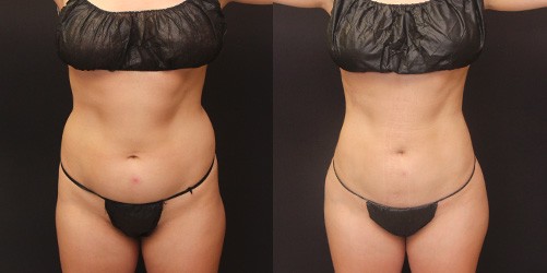 before after image liposuction procedure patient 9