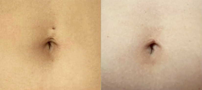 Belly Button Piercing Removal Before and After Gabbay Plastic Surgery