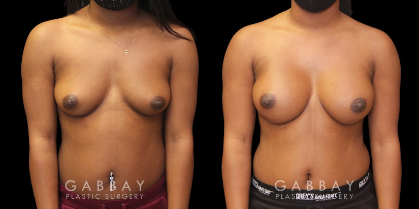 Before-and-after breast augmentation showing improved volume while keeping a natural look to how the breasts lie on the chest.