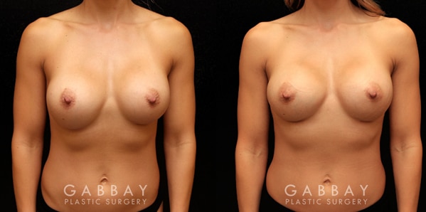 Patient 06 Front View Breast Revision -Remove and Replace Saline & Full Lift Gabbay Plastic Surgery