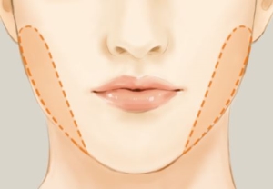 buccal-fat-11