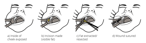 Buccal Fat Pad Removal Procedure Dr Gabbay