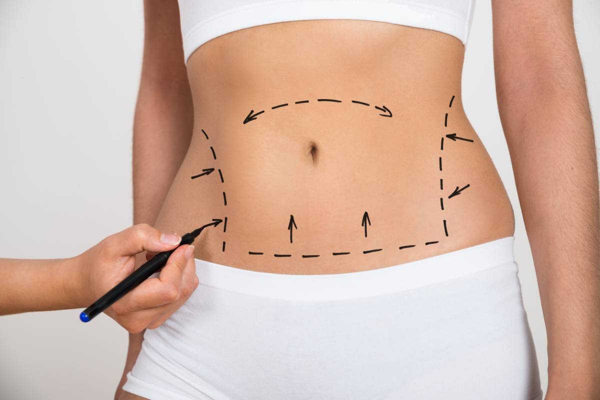 CoolSculpting vs. Liposuction - 3 Difference in the Procedures