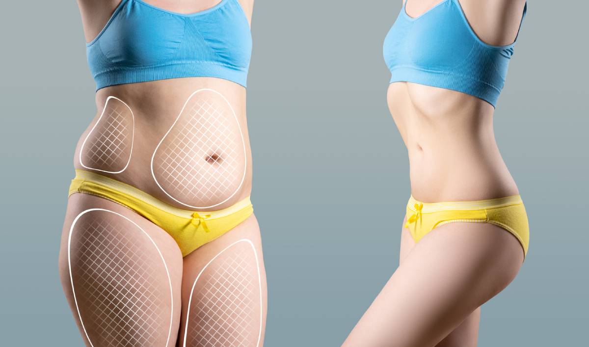featured image for can liposuction be combined with other cosmetic procedures