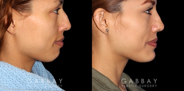 Patient 01 Right Side View Chin Implant Before and After Gabbay Plastic Surgery