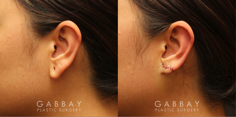 Patient 05 Left Side View Earlobe Repair Gabbay Plastic Surgery