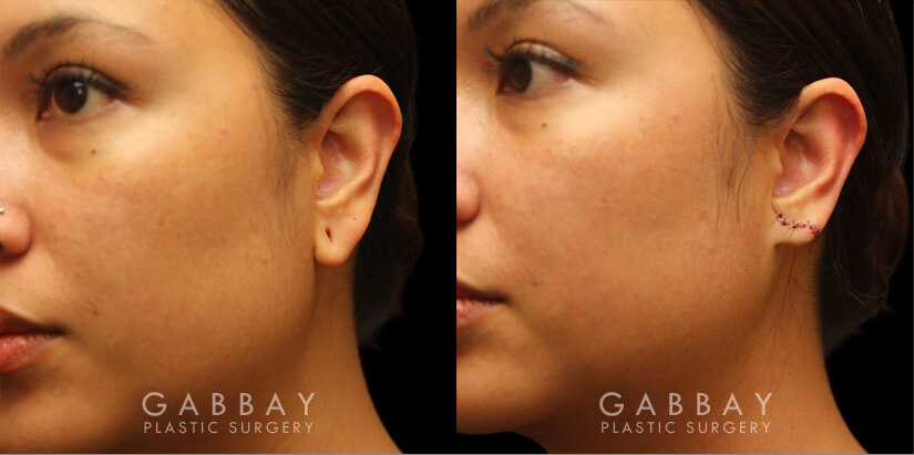 Patient 05 3/4th Left Side View Earlobe Repair Gabbay Plastic Surgery