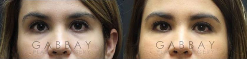 Patient 01 Before And After Picture Dermal Fillers Gabbay Plastic Surgery