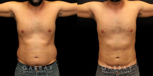 Patient 01 Front View Gynecomastia Before and After Gabbay Plastic Surgery