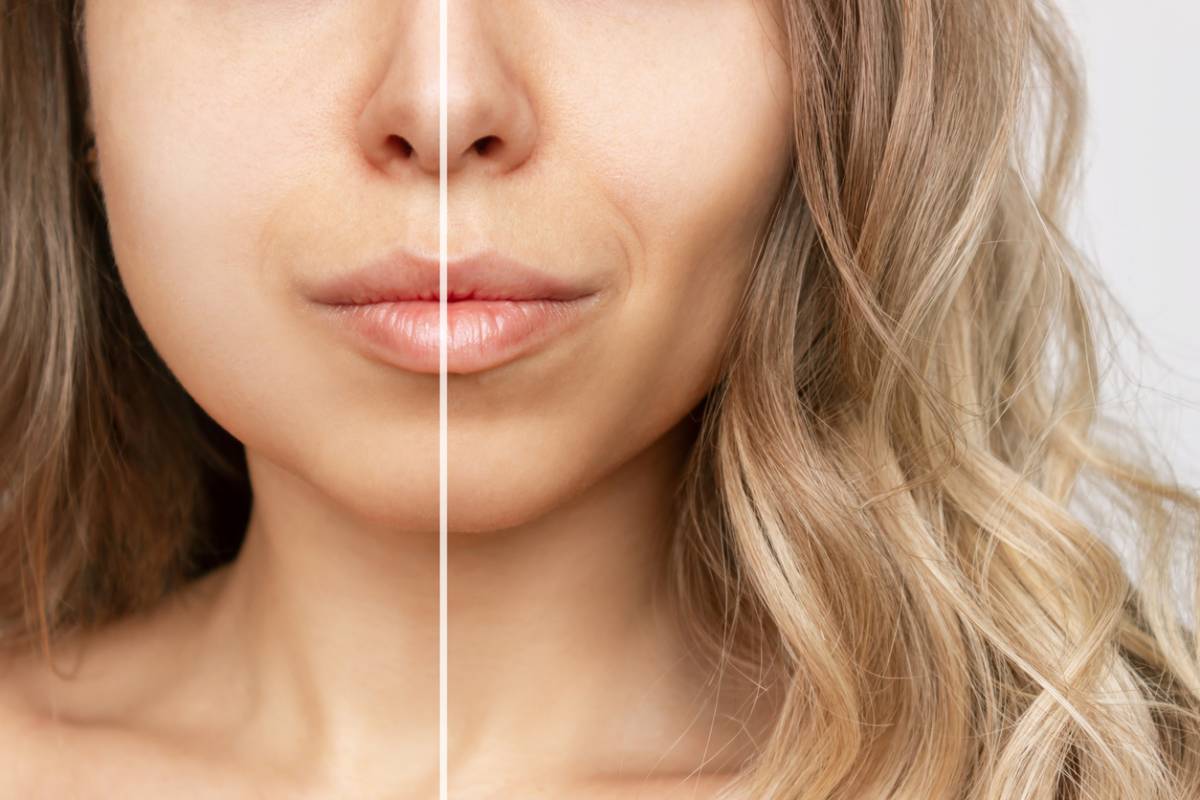 Example of how buccal fat removal changes facial shape