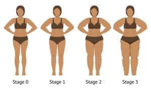 Secondary image for Is Lipedema Genetic?