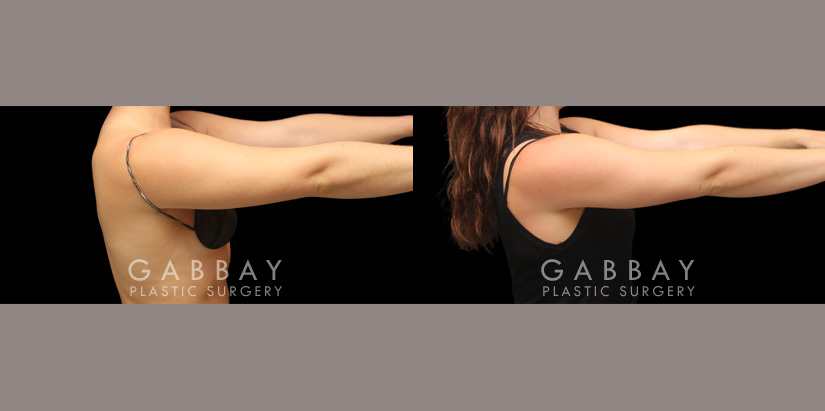 Patient 27 Right View Lipo Arms Gabbay Plastic Surgery