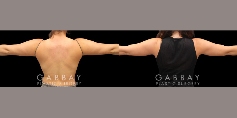 Patient 27 Back View Lipo Arms Gabbay Plastic Surgery