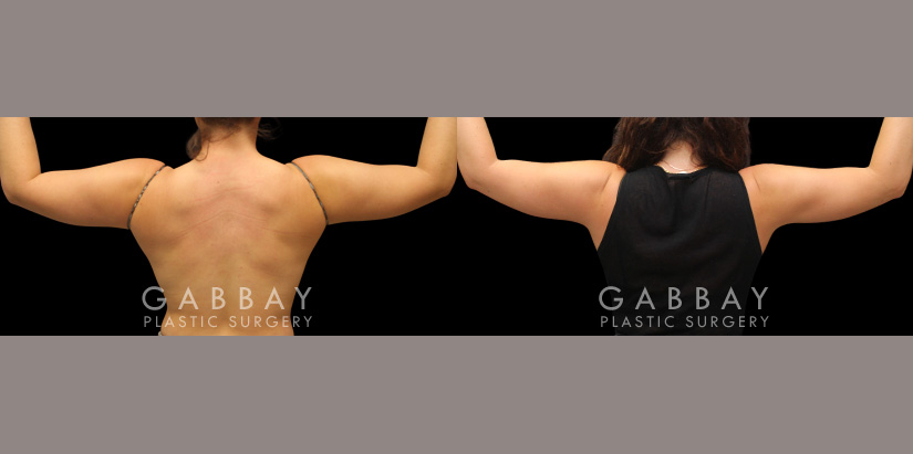 Patient 27 Back View Lipo Arms Gabbay Plastic Surgery