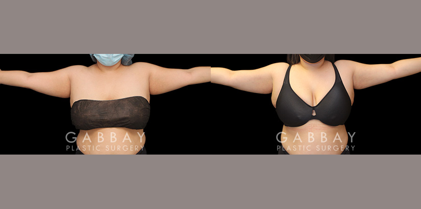 Patient 18 Front View Lipo Arms Gabbay Plastic Surgery