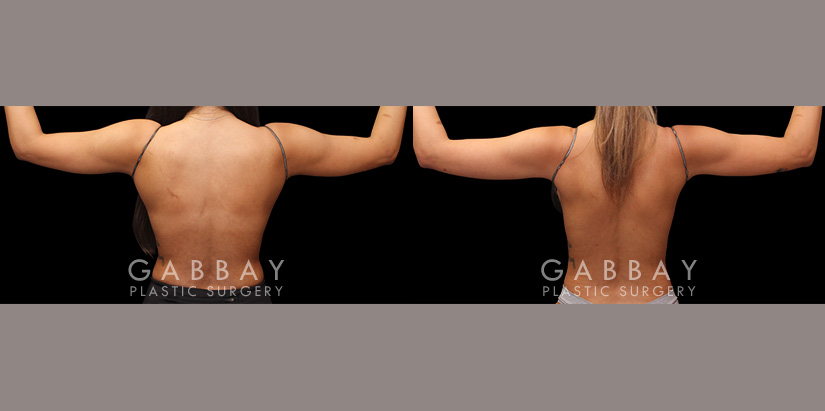 Patient 19 Back View Lipo Arms Gabbay Plastic Surgery