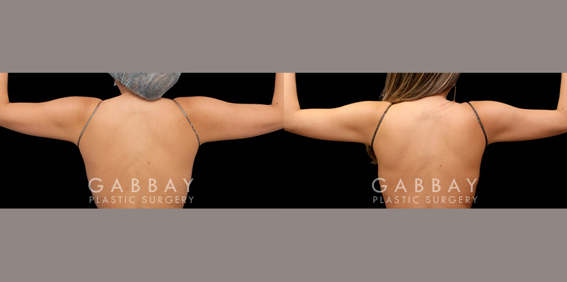 Patient 20 Back View Lipo Arms Gabbay Plastic Surgery