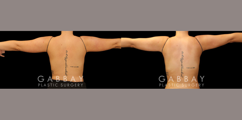 Patient 22 Back View Lipo Arms Gabbay Plastic Surgery