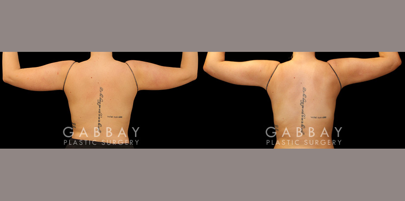 Patient 22 Back View Lipo Arms Gabbay Plastic Surgery