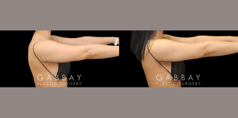 Patient 23 Right View Lipo Arms Gabbay Plastic Surgery