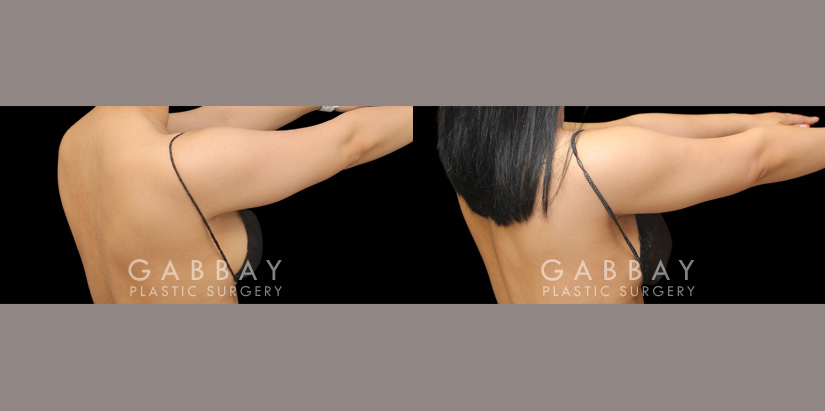 Patient 23 3/4th Right View Lipo Arms Gabbay Plastic Surgery