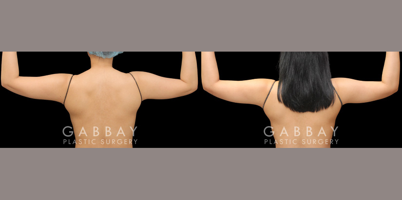 Patient 23 Back View Lipo Arms Gabbay Plastic Surgery