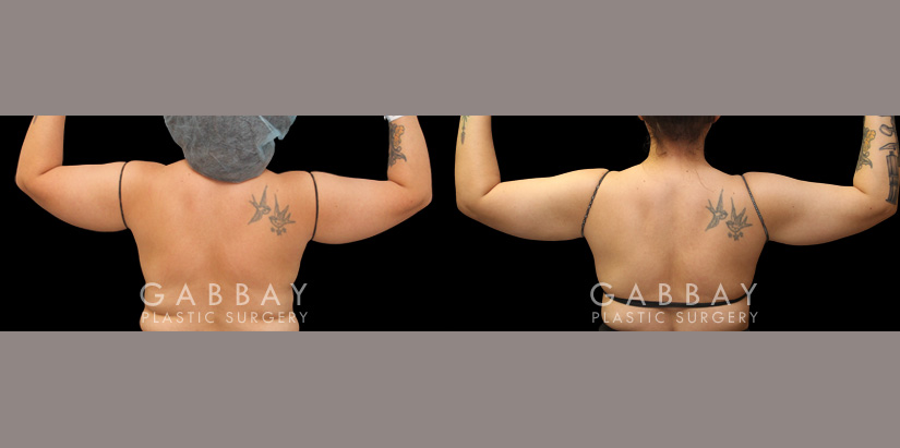 Patient 24 Back View Lipo Arms Gabbay Plastic Surgery