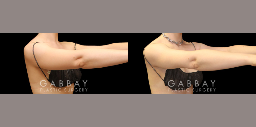Patient 25 Right View Lipo Arms Gabbay Plastic Surgery