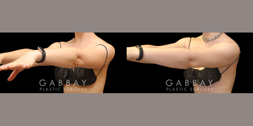 Patient 25 Left View Lipo Arms Gabbay Plastic Surgery