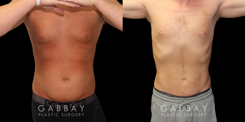 Male liposuction results before and after the procedure, showing the tighter abdomen. Note the significant improvement shown when sitting, showcasing the reduced belly fat from lipo.