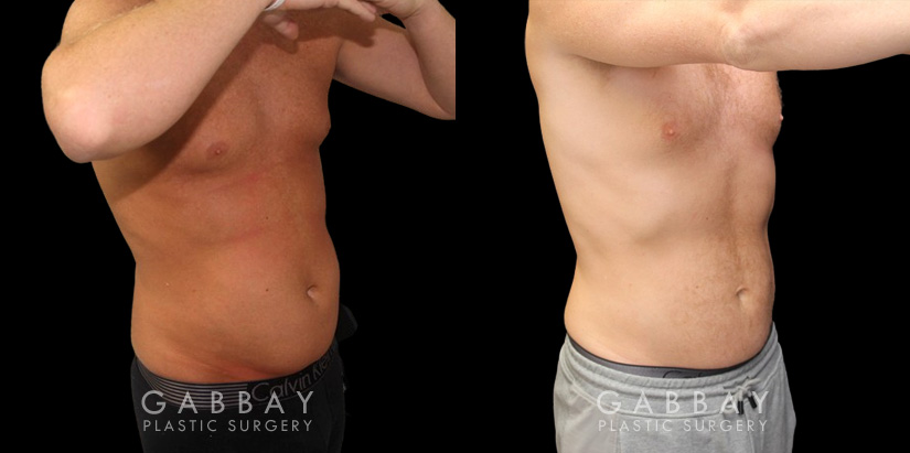 Male liposuction results before and after the procedure, showing the tighter abdomen. Note the significant improvement shown when sitting, showcasing the reduced belly fat from lipo.