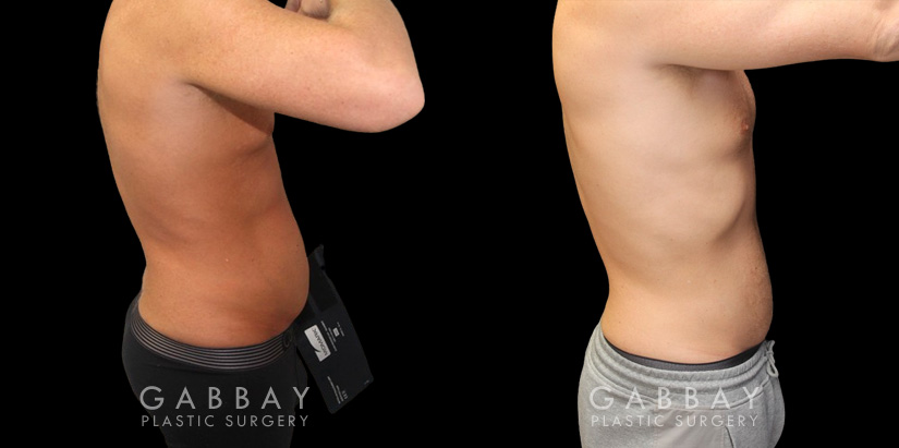 Male liposuction results before and after the procedure, showing the tighter abdomen. Note the significant improvement shown when sitting, showcasing the reduced belly fat from lipo.