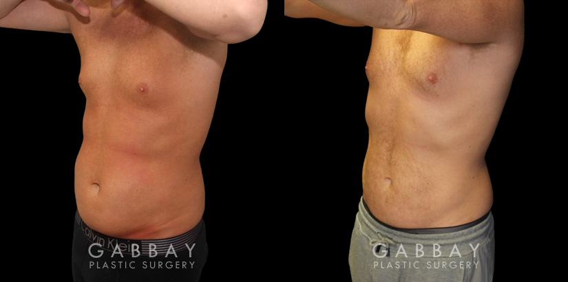 Male liposuction results before and after the procedure, showing the tighter abdomen. Note the significant improvement shown when sitting, showcasing the reduced belly fat from lipo.