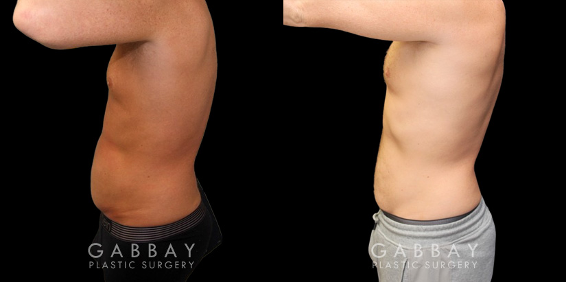 Male liposuction results before and after the procedure, showing the tighter abdomen. Note the significant improvement shown when sitting, showcasing the reduced belly fat from lipo.