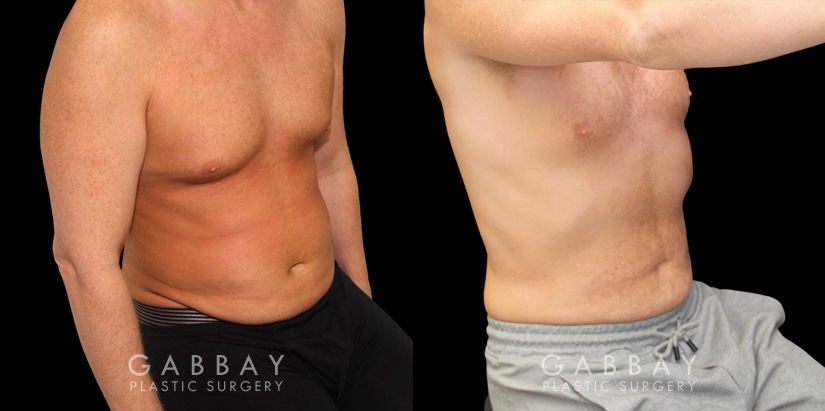 Male liposuction results before and after the procedure, showing the tighter abdomen. Note the significant improvement shown when sitting, showcasing the reduced belly fat from lipo.