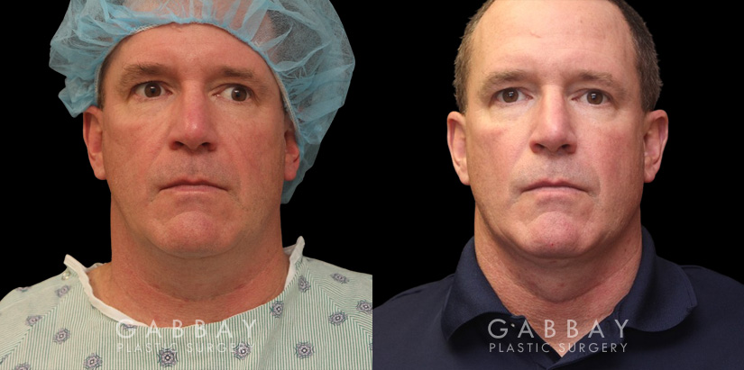 Male neck liposuction results for mid 50s man. Photos demonstrate the contour around the jawline for an overall enhanced masculine jawline contour. Though subtle and refined, the results are noticeable from multiple angles.