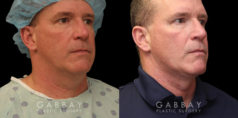 Male neck liposuction results for mid 50s man. Photos demonstrate the contour around the jawline for an overall enhanced masculine jawline contour. Though subtle and refined, the results are noticeable from multiple angles.