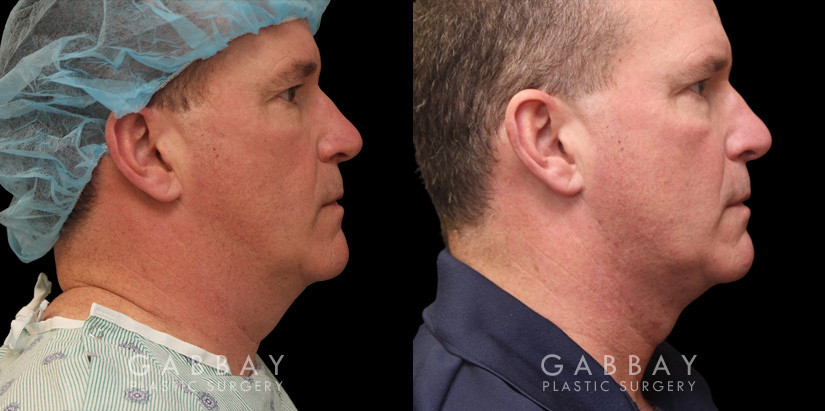 Male neck liposuction results for mid 50s man. Photos demonstrate the contour around the jawline for an overall enhanced masculine jawline contour. Though subtle and refined, the results are noticeable from multiple angles.