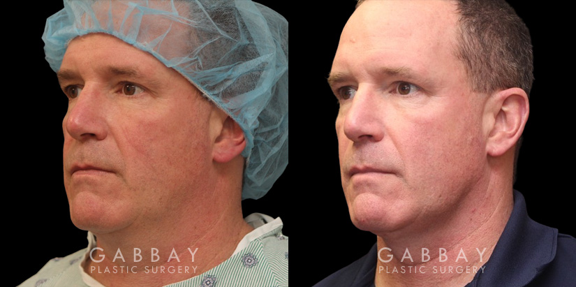Patient 6 3/4thLeft Side View Lipo Male Gabbay Plastic Surgery