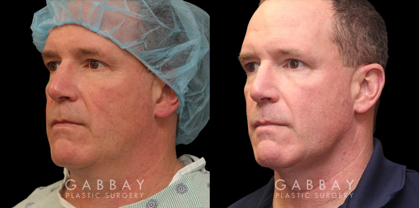 Male neck liposuction results for mid 50s man. Photos demonstrate the contour around the jawline for an overall enhanced masculine jawline contour. Though subtle and refined, the results are noticeable from multiple angles.