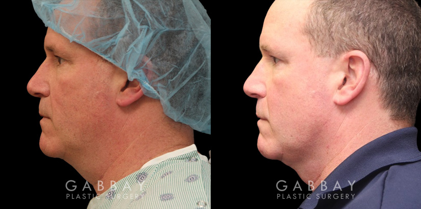 Male neck liposuction results for mid 50s man. Photos demonstrate the contour around the jawline for an overall enhanced masculine jawline contour. Though subtle and refined, the results are noticeable from multiple angles.