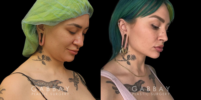 Patient 13 3/4th Right Side View Lipo Neck Gabbay Plastic Surgery