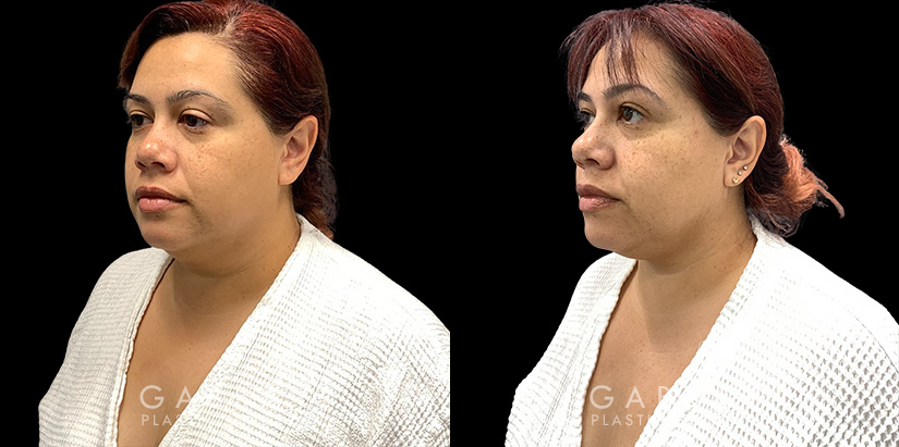 Patient 12 3/4th Left Side View Lipo Neck Gabbay Plastic Surgery