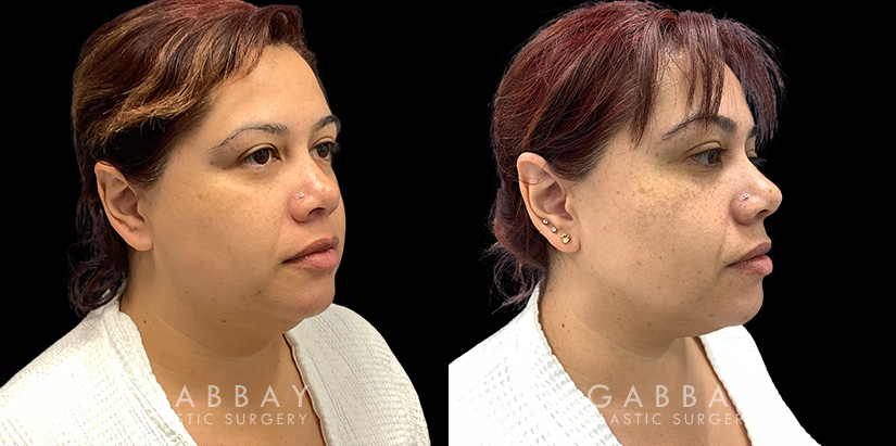 Patient 12 3/4th Right Side View Lipo Neck Gabbay Plastic Surgery