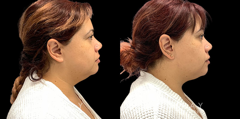 Patient 12 Right Side View Lipo Neck Gabbay Plastic Surgery