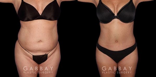 Patient 01 Front View Liposuction Before and After Gabbay Plastic Surgery