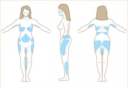 graphic depicting prime liposuction suitable areas of body