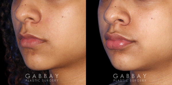 Patient 01 3/4th Left Side View Lip Augmentation Before and After Gabbay Plastic Surgery