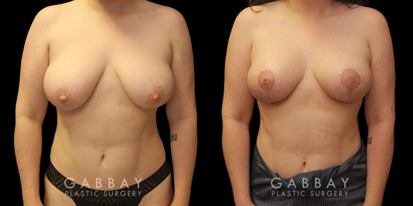 Patient 27 Front View Breast Mastopexy Gabbay Plastic Surgery
